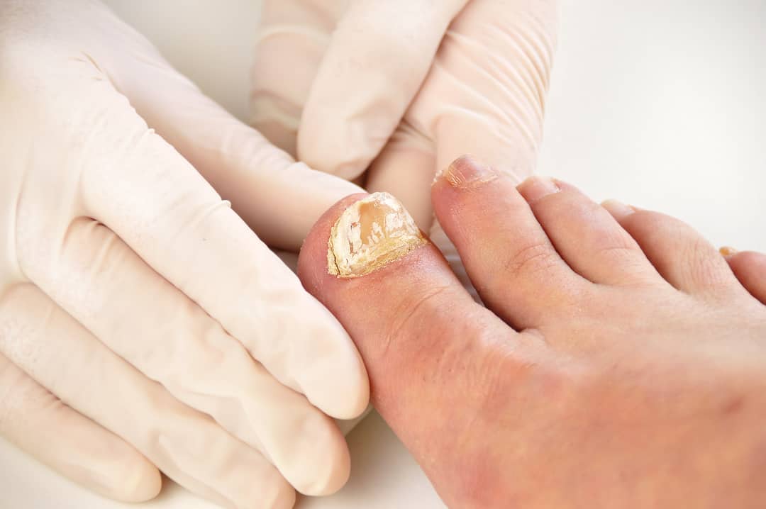 Powdery Nails: Symptoms and Treatment