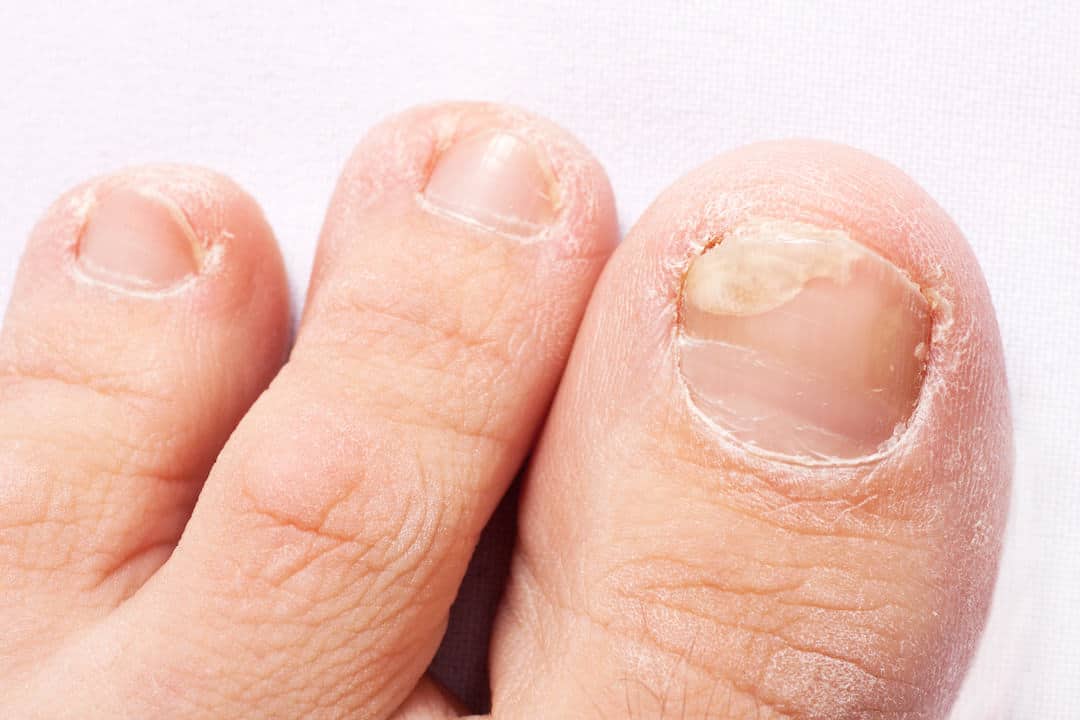 Yellow Nails: A Common Infection